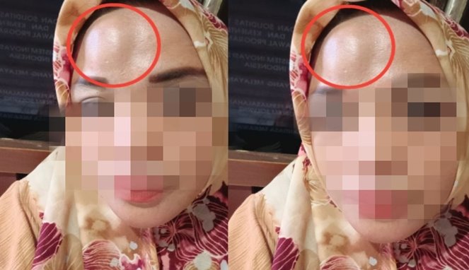 Korban seorang wanita yang dianaya Hingga Benjol
